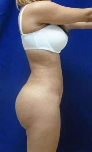 Brazilian Butt Lift after, case 1054, side view (Female, 25: BBL (1,300 cc per side))