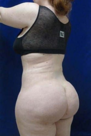 Brazilian Butt Lift after, case 1053, angle view (Female, 20: BBL (1,200 cc per side))