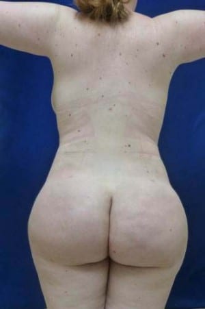 Brazilian Butt Lift after, case 1053, back view (Female, 20: BBL (1,200 cc per side))