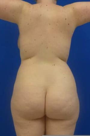 Brazilian Butt Lift before, case 1053, back view (Female, 20: BBL (1,200 cc per side))