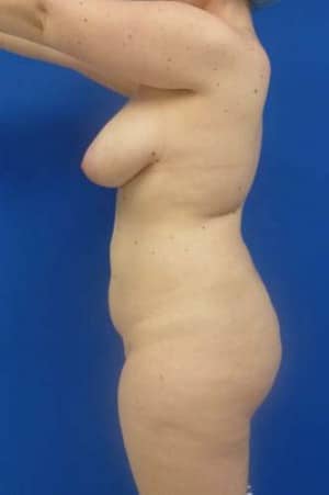 Brazilian Butt Lift before, case 1053, side view (Female, 20: BBL (1,200 cc per side))