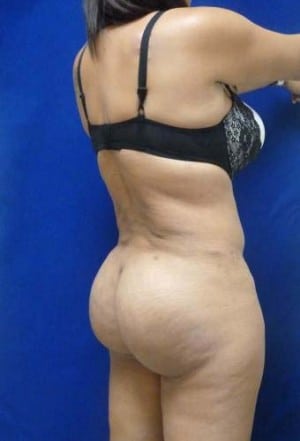 Brazilian Butt Lift after, case 1052, angle view (Female, 34: BBL (1,300 cc per side))