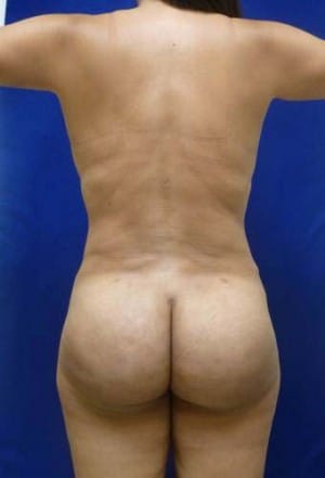 Brazilian Butt Lift after, case 1052, back view (Female, 34: BBL (1,300 cc per side))