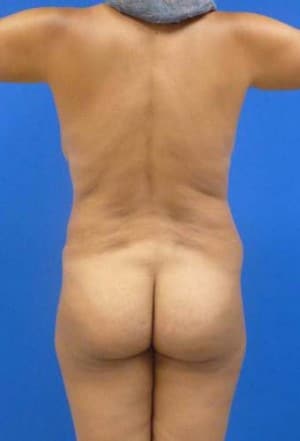 Brazilian Butt Lift before, case 1052, back view (Female, 34: BBL (1,300 cc per side))