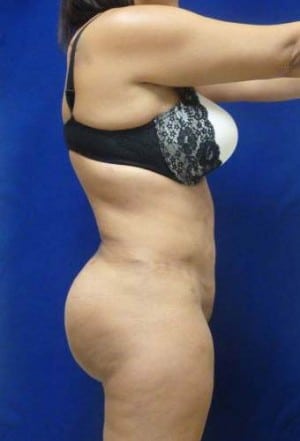 Brazilian Butt Lift after, case 1052, side view (Female, 34: BBL (1,300 cc per side))