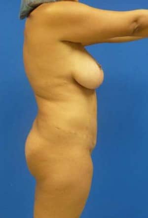 Brazilian Butt Lift before, case 1052, side view (Female, 34: BBL (1,300 cc per side))