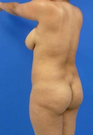 Brazilian Butt Lift before, case 1051, angle view (Female, 25: BBL (1,400 cc per side))