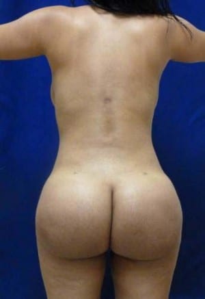 Brazilian Butt Lift after, case 1051, back view (Female, 25: BBL (1,400 cc per side))