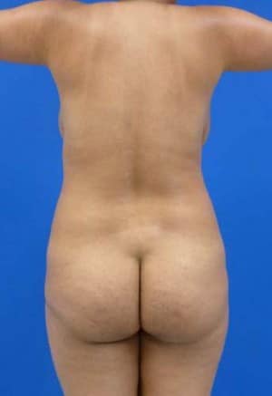 Brazilian Butt Lift before, case 1051, back view (Female, 25: BBL (1,400 cc per side))