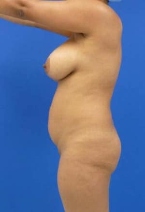 Brazilian Butt Lift before, case 1051, side view (Female, 25: BBL (1,400 cc per side))