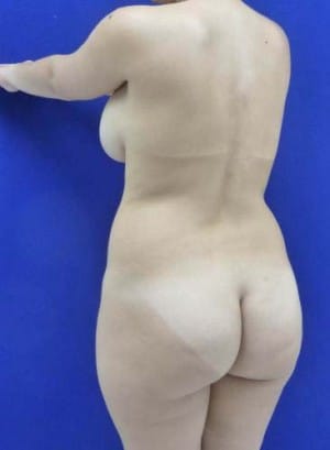 Brazilian Butt Lift before, case 1050, angle view (Female, 25: BBL (1,000 cc per side))