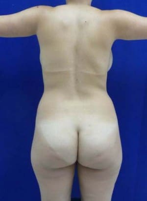 Brazilian Butt Lift before, case 1050, back view (Female, 25: BBL (1,000 cc per side))