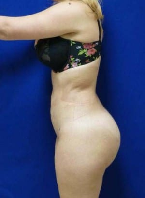 Brazilian Butt Lift after, case 1050, side view (Female, 25: BBL (1,000 cc per side))