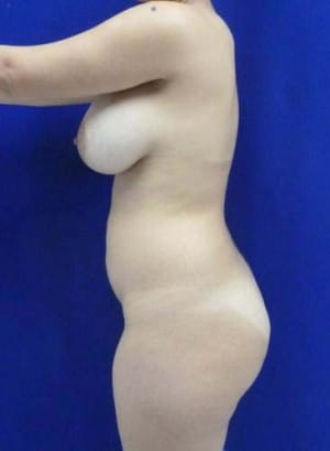 Brazilian Butt Lift before, case 1050, side view (Female, 25: BBL (1,000 cc per side))