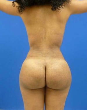 Brazilian Butt Lift after, case 1049, back view (Female, 23: BBL (1,150 cc per side))