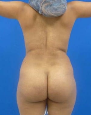 Brazilian Butt Lift before, case 1049, back view (Female, 23: BBL (1,150 cc per side))
