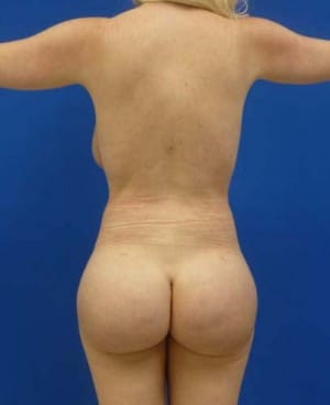 Brazilian Butt Lift after, case 1048, back view (Female, 25: BBL (1,050 cc per side))