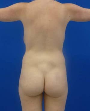 Brazilian Butt Lift before, case 1048, back view (Female, 25: BBL (1,050 cc per side))