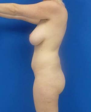 Brazilian Butt Lift before, case 1048, side view (Female, 25: BBL (1,050 cc per side))