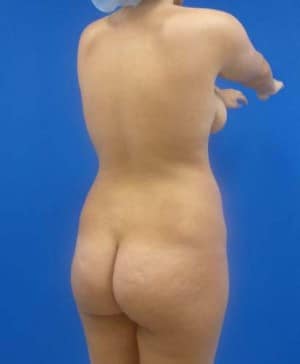 Brazilian Butt Lift before, case 1047, angle view (Female, 24: BBL (1,150 cc per side))