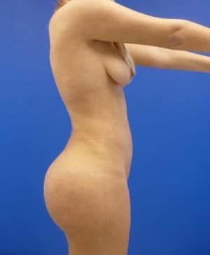Brazilian Butt Lift after, case 1047, side view (Female, 24: BBL (1,150 cc per side))