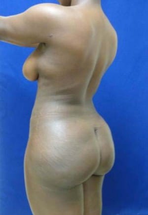 Brazilian Butt Lift after, case 1046, angle view (Female, 34: BBL (1,250 cc per side))