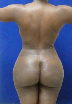 Brazilian Butt Lift after, case 1046, back view (Female, 34: BBL (1,250 cc per side))