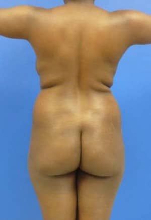 Brazilian Butt Lift before, case 1046, back view (Female, 34: BBL (1,250 cc per side))