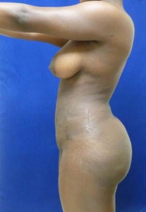 Brazilian Butt Lift after, case 1046, side view (Female, 34: BBL (1,250 cc per side))