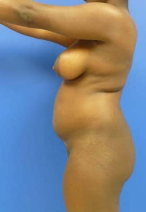 Brazilian Butt Lift before, case 1046, side view (Female, 34: BBL (1,250 cc per side))