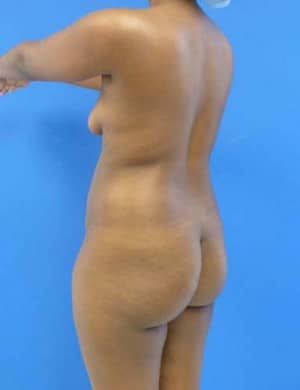 Brazilian Butt Lift before, case 1045, angle view (Female, 27: BBL (1,300 cc per side))