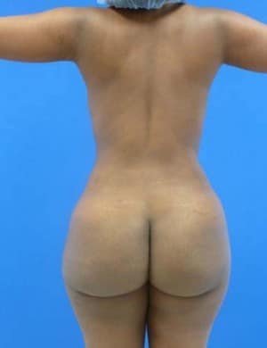 Brazilian Butt Lift after, case 1045, back view (Female, 27: BBL (1,300 cc per side))