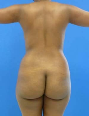 Brazilian Butt Lift before, case 1045, back view (Female, 27: BBL (1,300 cc per side))
