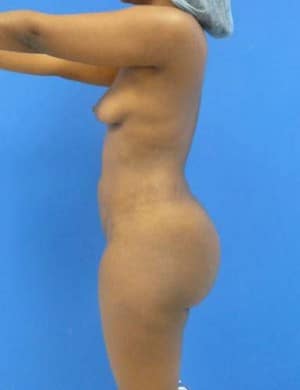 Brazilian Butt Lift after, case 1045, side view (Female, 27: BBL (1,300 cc per side))