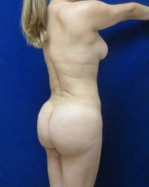 Brazilian Butt Lift after, case 1044, angle view (Female, 35: BBL (750 cc per side))