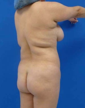Brazilian Butt Lift before, case 1044, angle view (Female, 35: BBL (750 cc per side))
