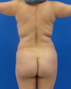 Brazilian Butt Lift before, case 1044, back view (Female, 35: BBL (750 cc per side))