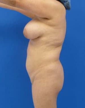 Brazilian Butt Lift before, case 1044, side view (Female, 35: BBL (750 cc per side))