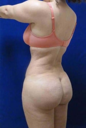 Brazilian Butt Lift after, case 1043, angle view (Female, 34: BBL (1,050 cc per side))