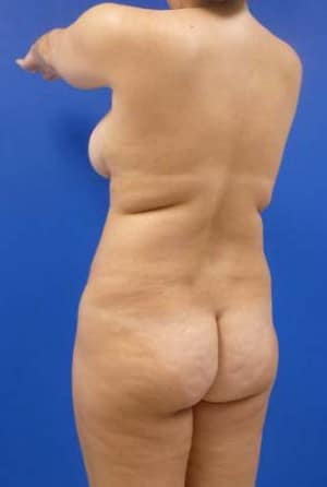 Brazilian Butt Lift before, case 1043, angle view (Female, 34: BBL (1,050 cc per side))