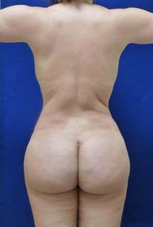 Brazilian Butt Lift after, case 1043, back view (Female, 34: BBL (1,050 cc per side))