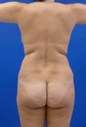Brazilian Butt Lift before, case 1043, back view (Female, 34: BBL (1,050 cc per side))