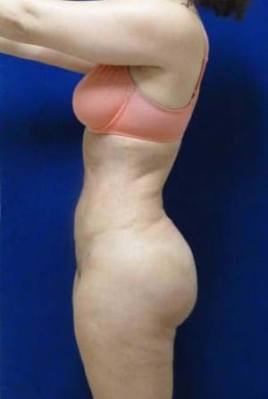 Brazilian Butt Lift after, case 1043, side view (Female, 34: BBL (1,050 cc per side))