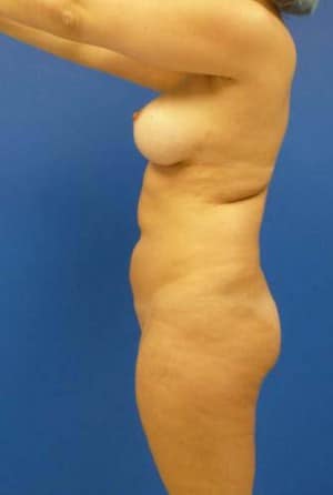 Brazilian Butt Lift before, case 1043, side view (Female, 34: BBL (1,050 cc per side))