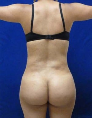 Brazilian Butt Lift after, case 1042, back view (Female, 24: BBL (800 cc per side))