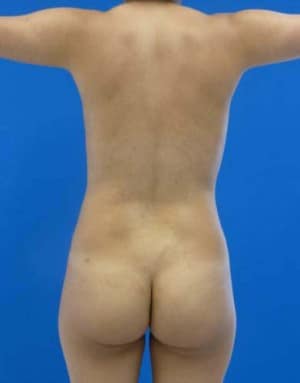 Brazilian Butt Lift before, case 1042, back view (Female, 24: BBL (800 cc per side))