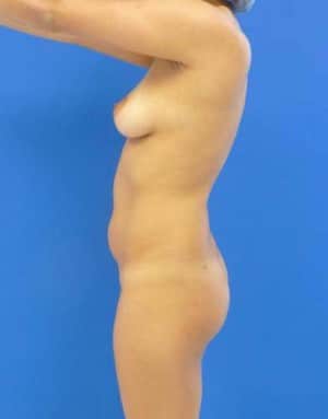 Brazilian Butt Lift before, case 1042, side view (Female, 24: BBL (800 cc per side))