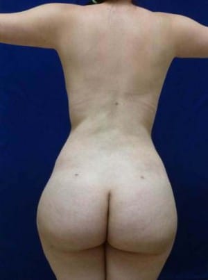 Brazilian Butt Lift after, case 1040, back view (Female, 25: BBL (1,050 cc per side))