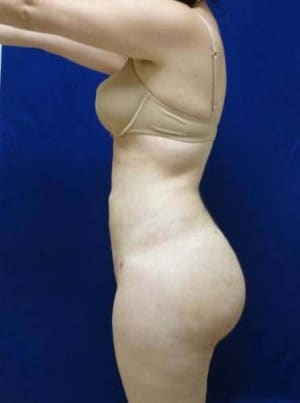 Brazilian Butt Lift after, case 1040, side view (Female, 25: BBL (1,050 cc per side))
