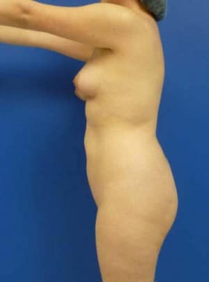 Brazilian Butt Lift before, case 1040, side view (Female, 25: BBL (1,050 cc per side))